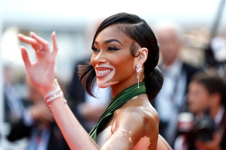 Modella con vitiligine Winnie Harlow