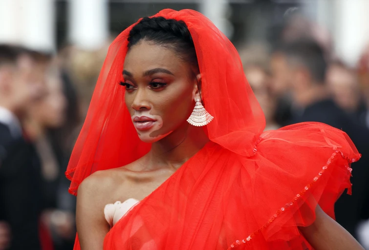 Modella con vitiligine Winnie Harlow