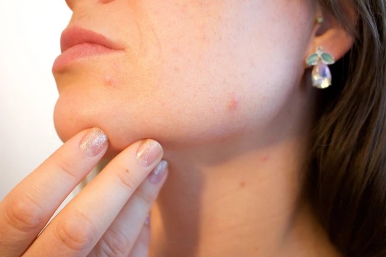Cosè la dermorexia quando la skincare diventa una malattia Ecco cosa preoccupa i dermatologi