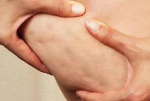 Cellulite nemica di tutte il 90 delle donne ci combatte ma si può davvero curare Ecco i due responsabili principali