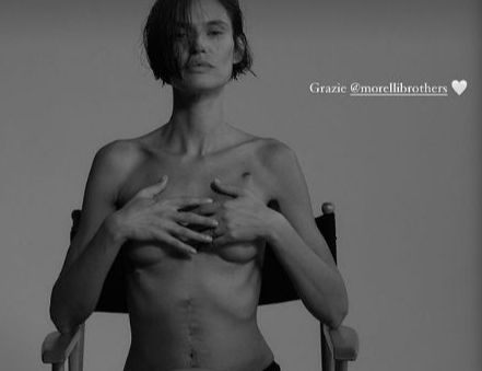 Bianca Balti si mostra nuda con la cicatrice e i capelli corti Oggi inizio la chemioterapia